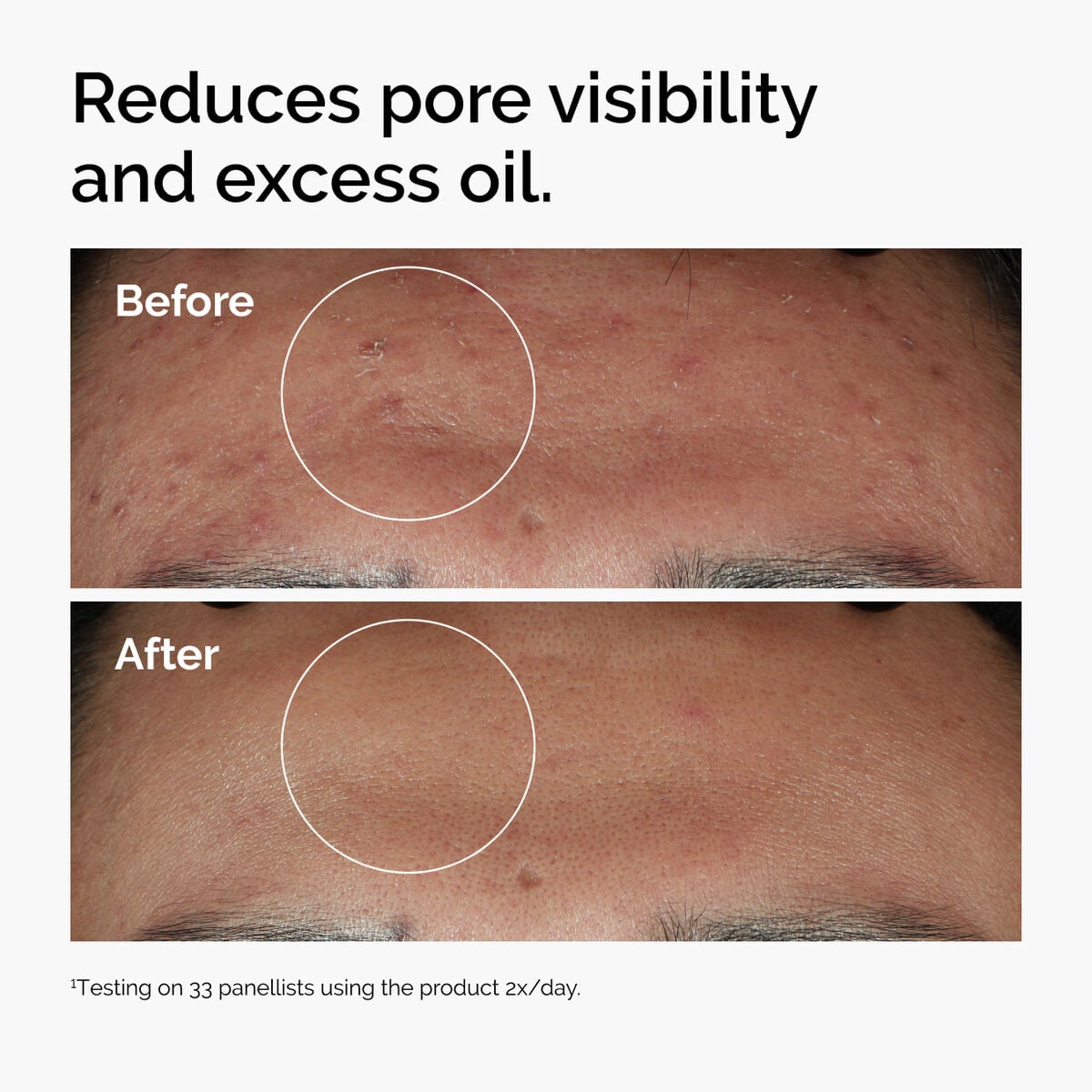 niacinamide-10-zinc-1-q0 ord-niacinamide-zinc-blemish-serum-before-after-pores.jpg