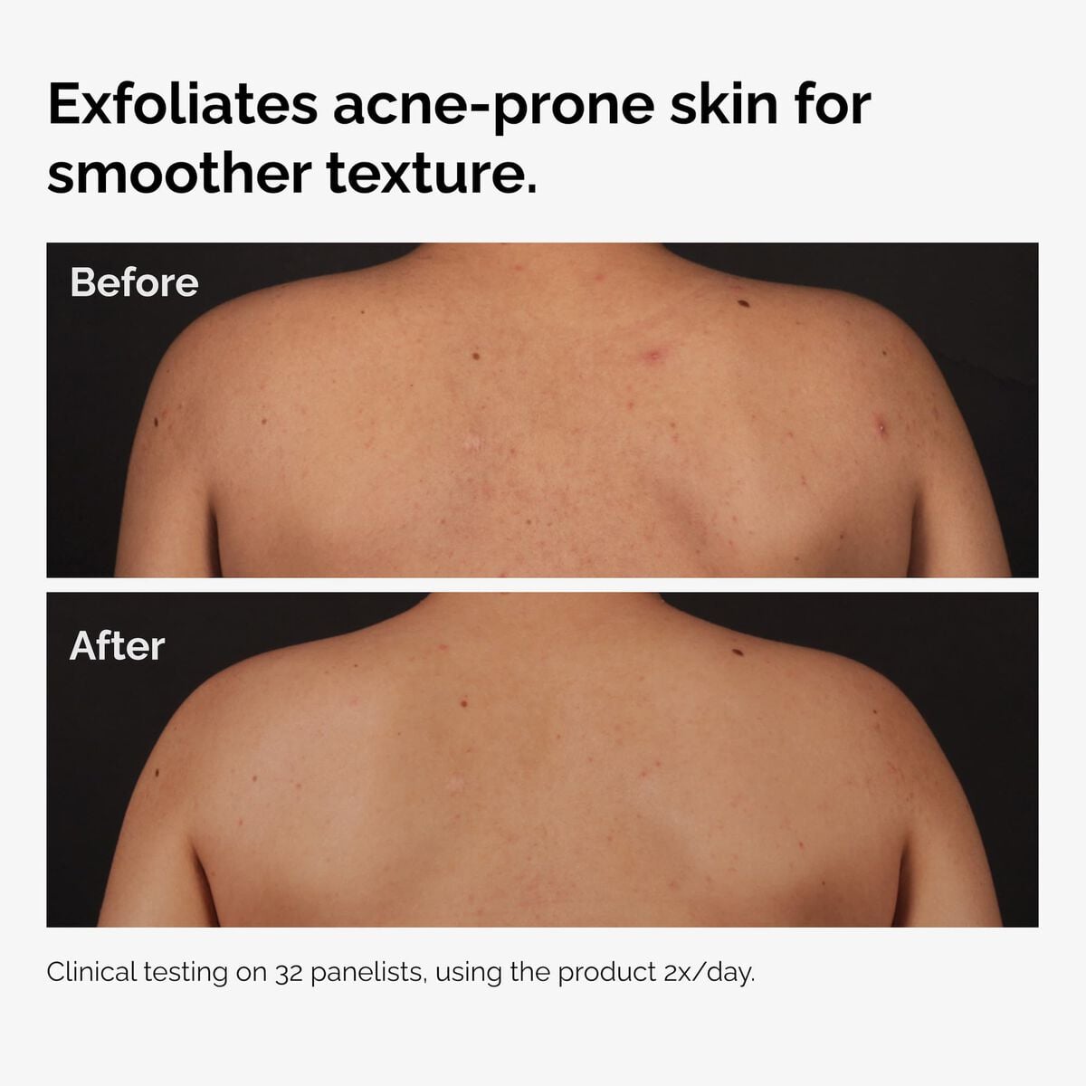 salicylic-acid-0-5-body-serum-c2 ord-salicylic-acid-body-serum-before-after-graphic-NA.jpg