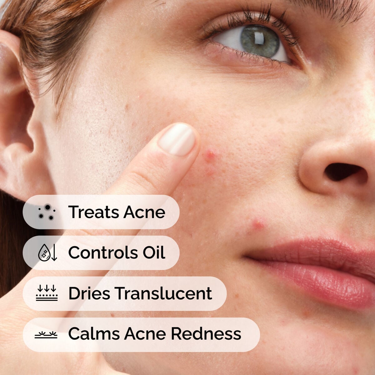 sulfur-10-powder-to-cream-concentrate-w8 ord-sulfur-10pct-powder-to-cream-concentrate-model-application-with-benefits-acne.jpg